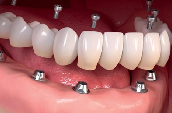 پرینتر سه بعدی در ایمپلنت دندانپزشکی